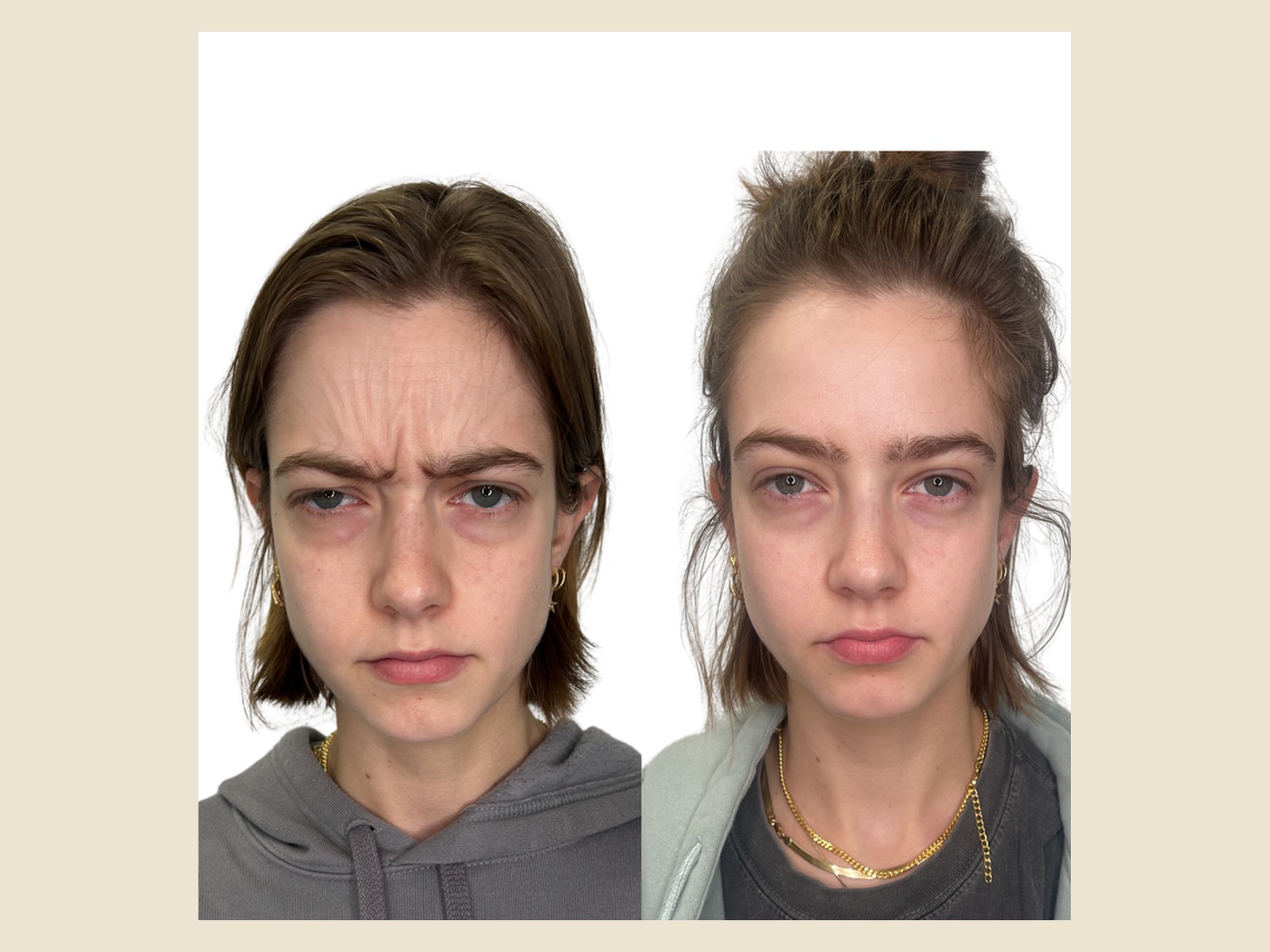 Neuromodulators before and after results at Roots in Tampa, FL