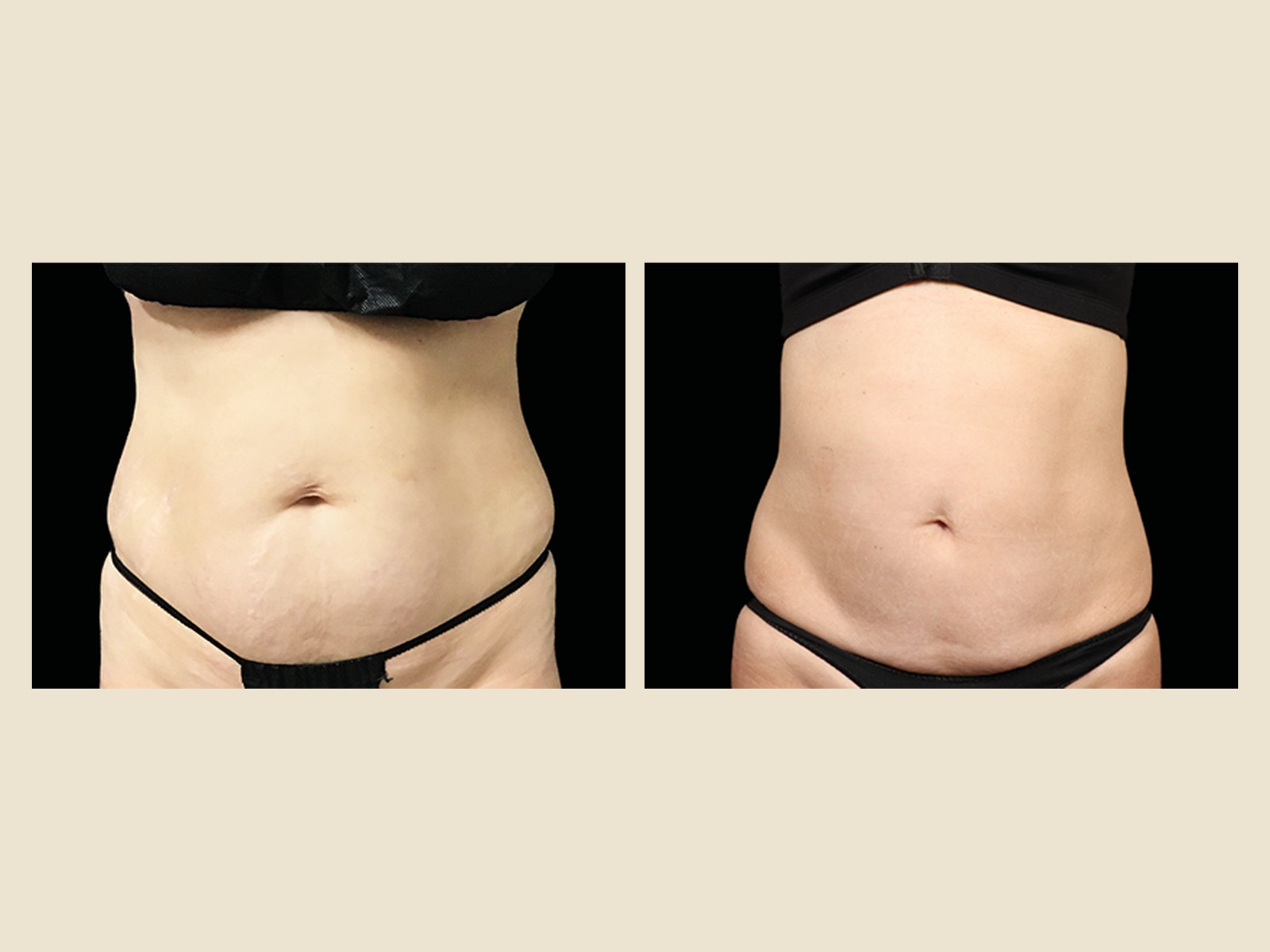 EmSculpt Neo abdominal toning results after a treatment series — Tampa patient
