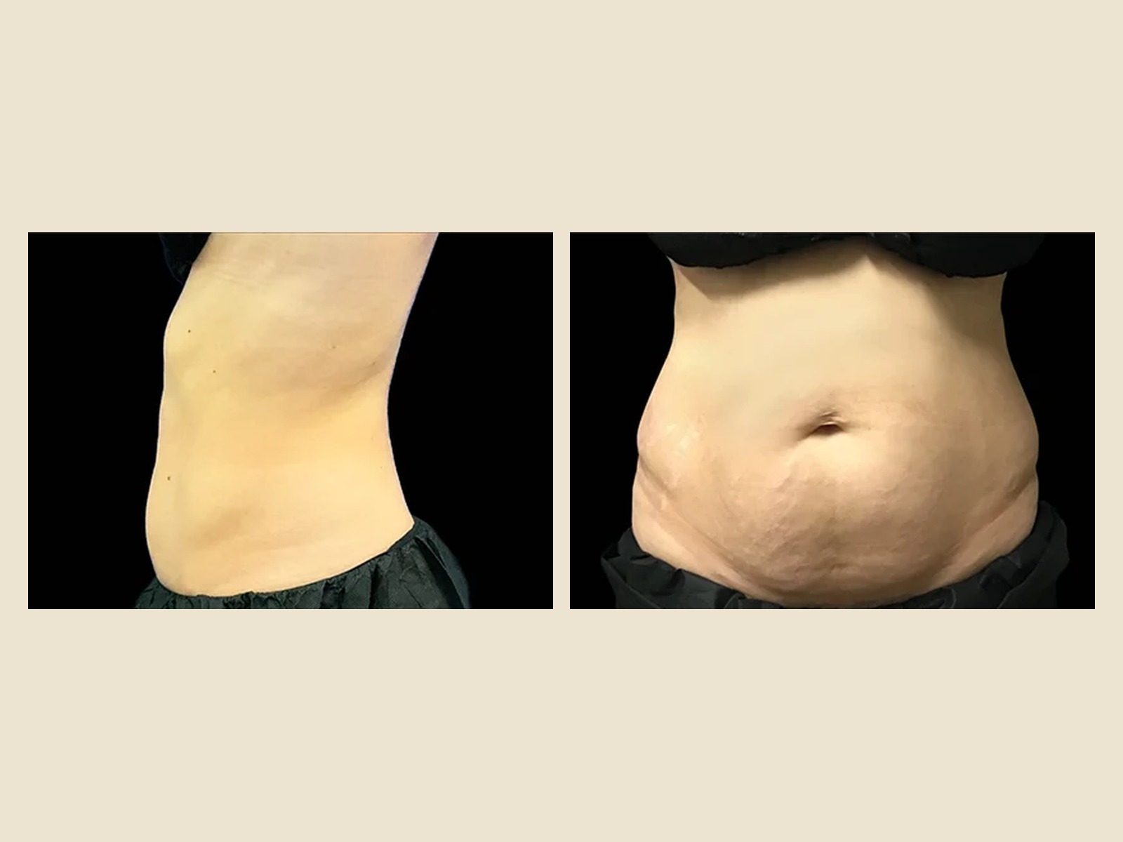 EmSculpt Neo muscle definition and fat reduction results — Tampa patient