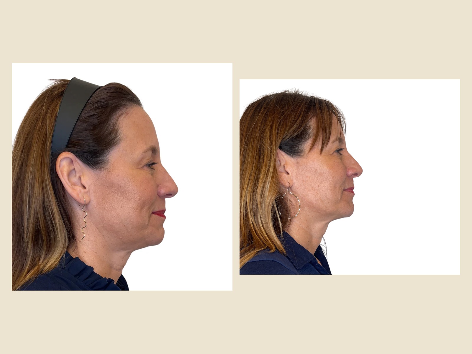Facial Balancing before and after results at Roots in Tampa, FL