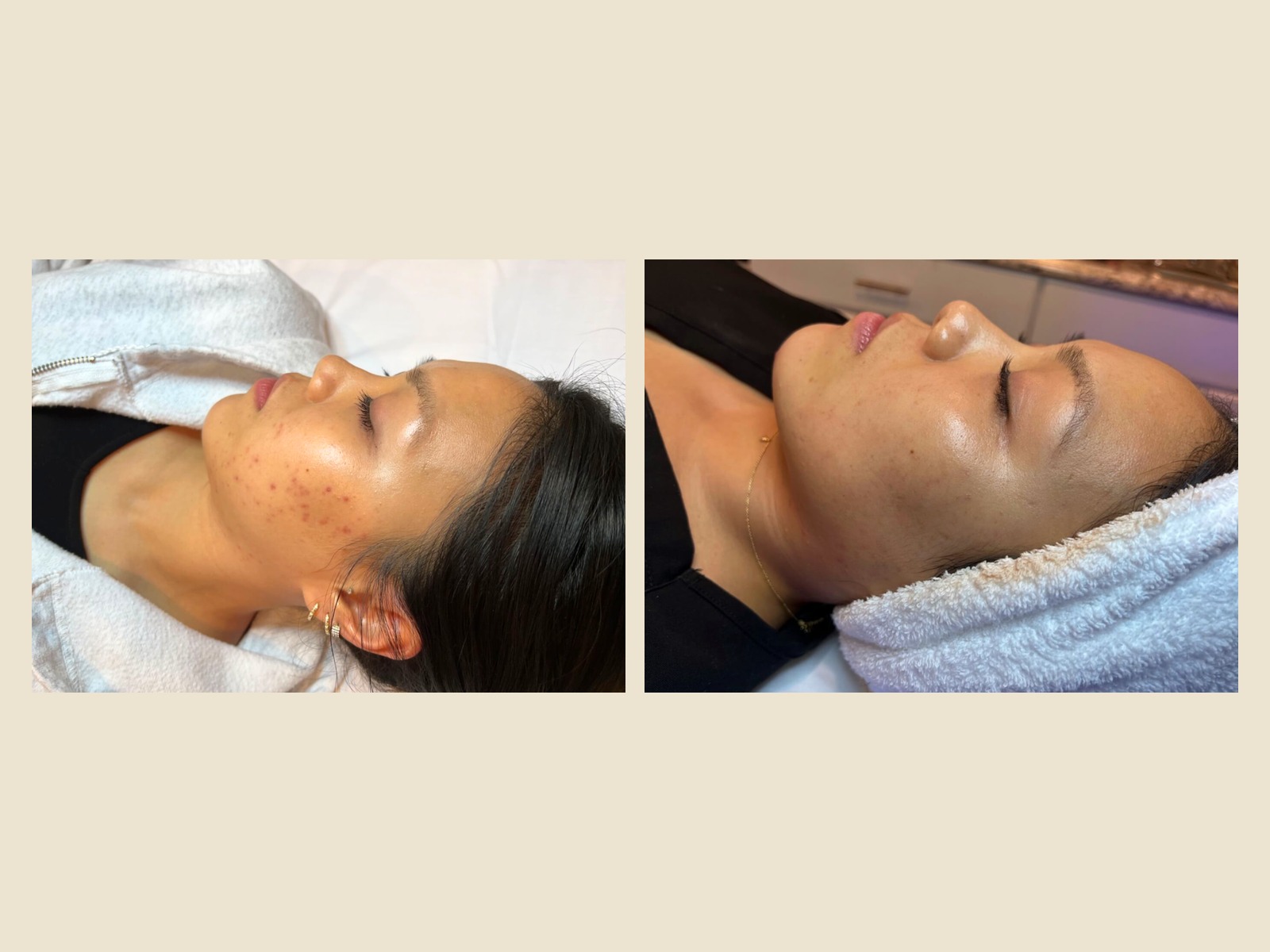 SkinPen® Microneedling before and after results at Roots in Tampa, FL