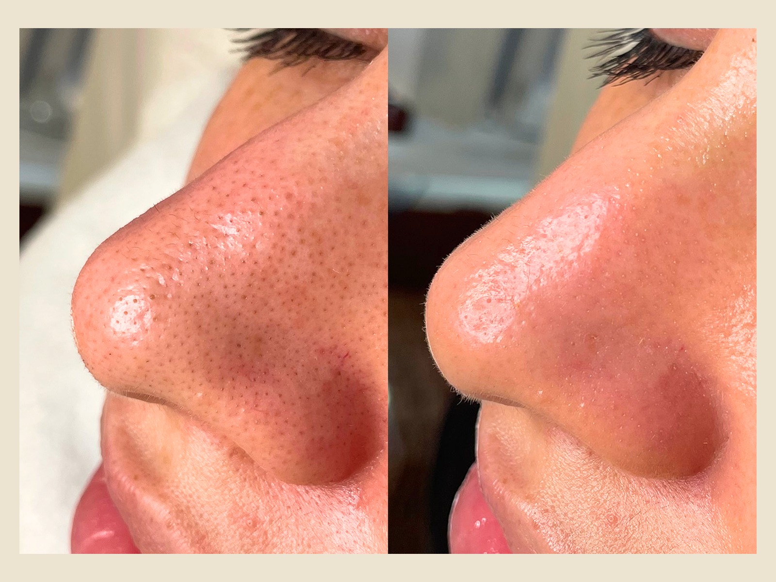 HydraFacial before and after results at Roots in Tampa, FL