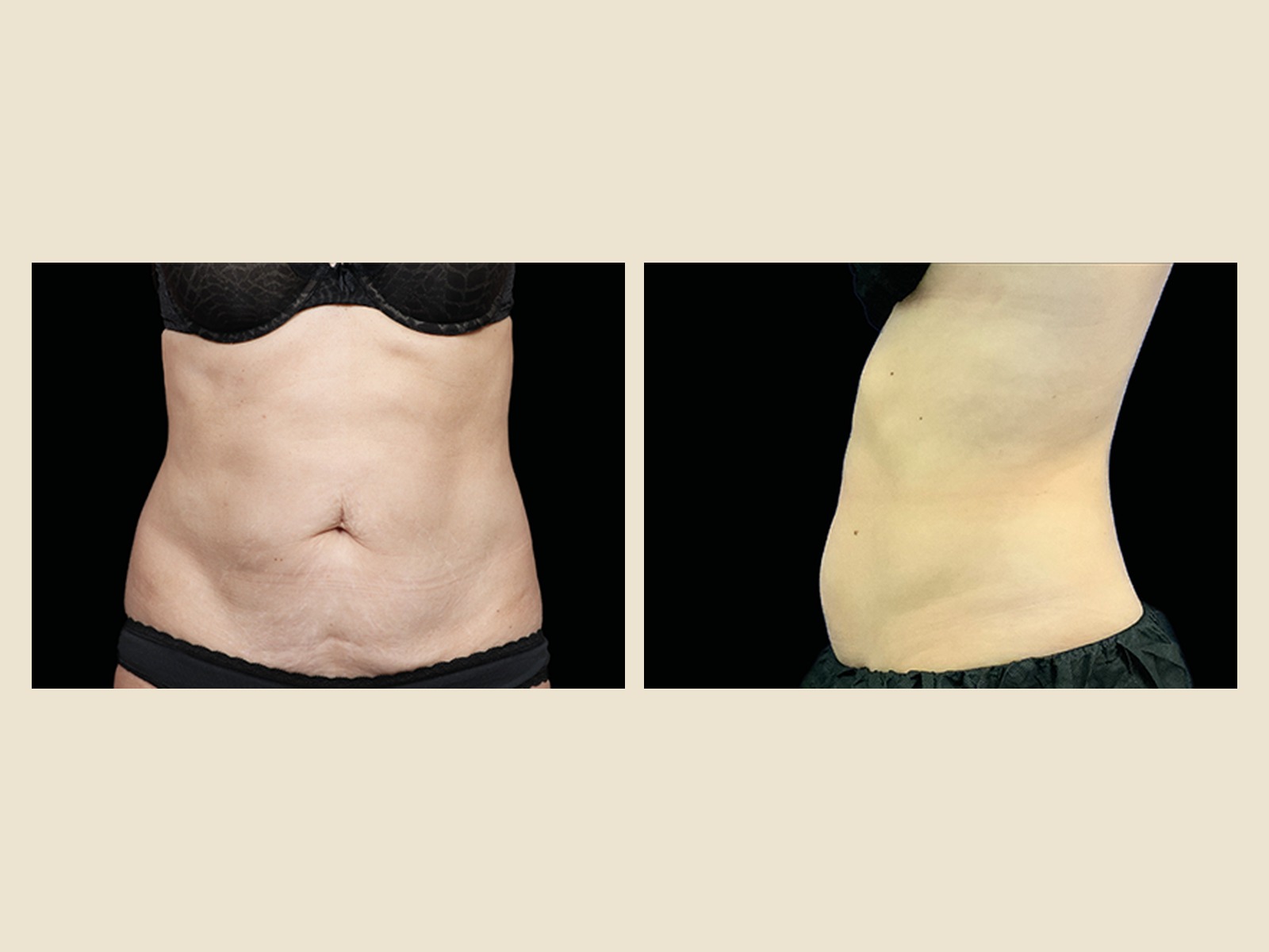EmSculpt Neo body contouring results — Tampa patient abdomen before and after