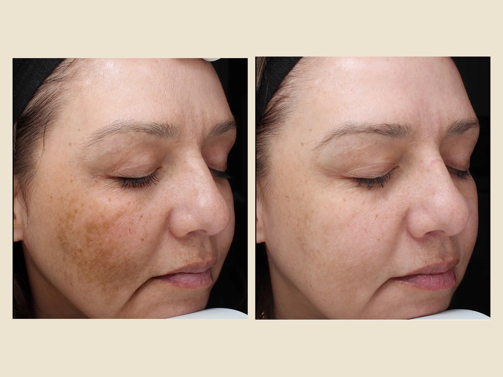 VI Chemical Peel before and after results at Roots in Tampa, FL