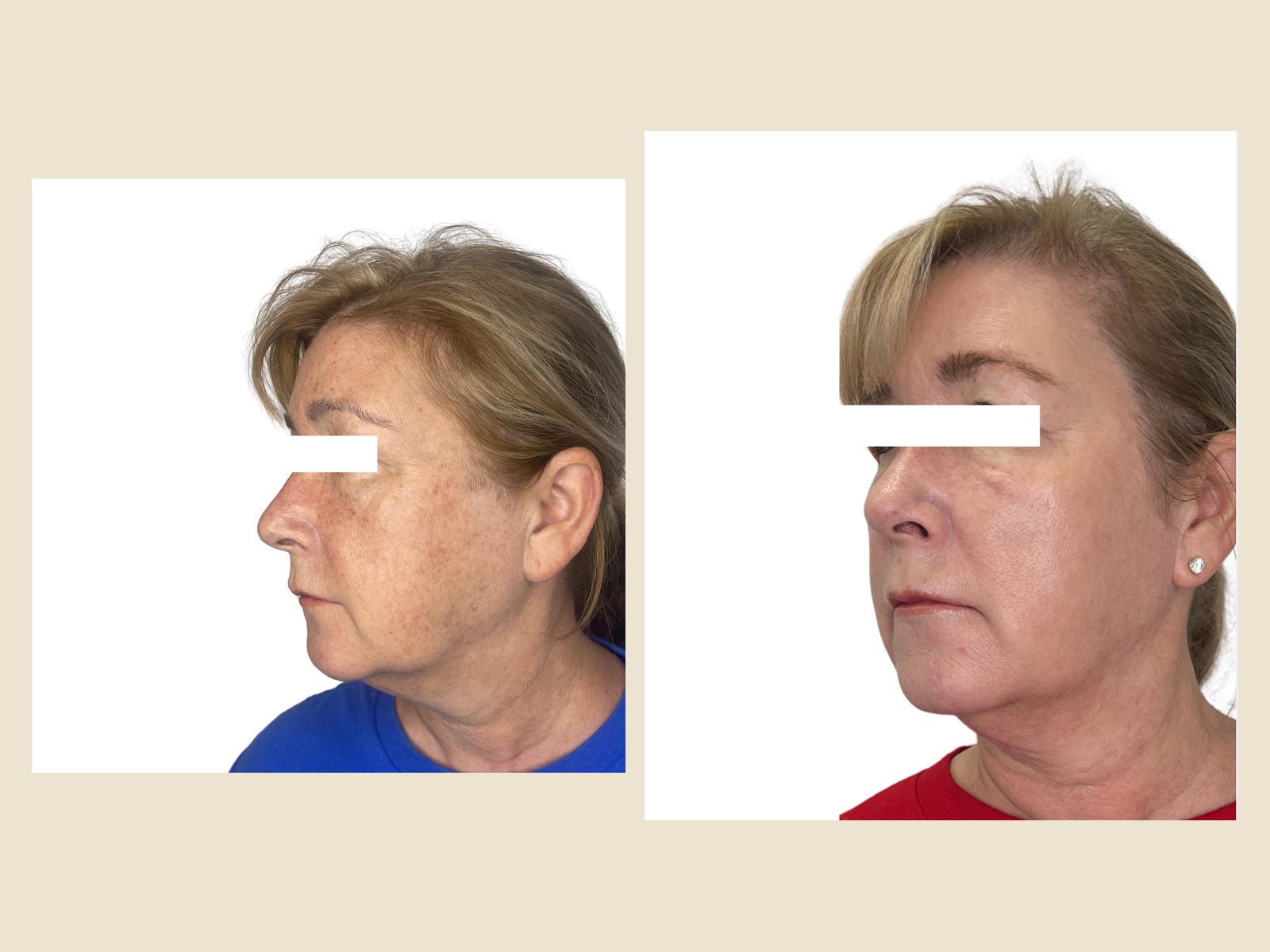 Lumecca IPL before and after results at Roots in Tampa, FL