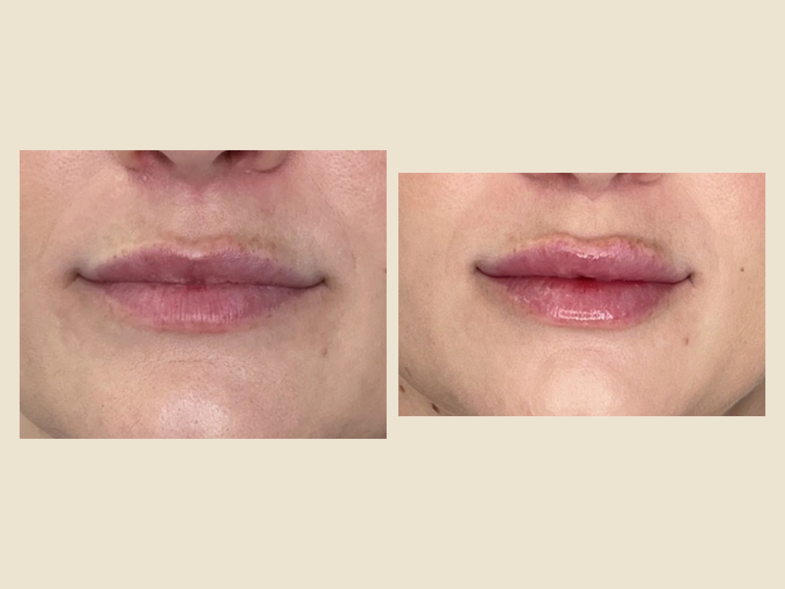Lip Filler before and after results at Roots in Tampa, FL