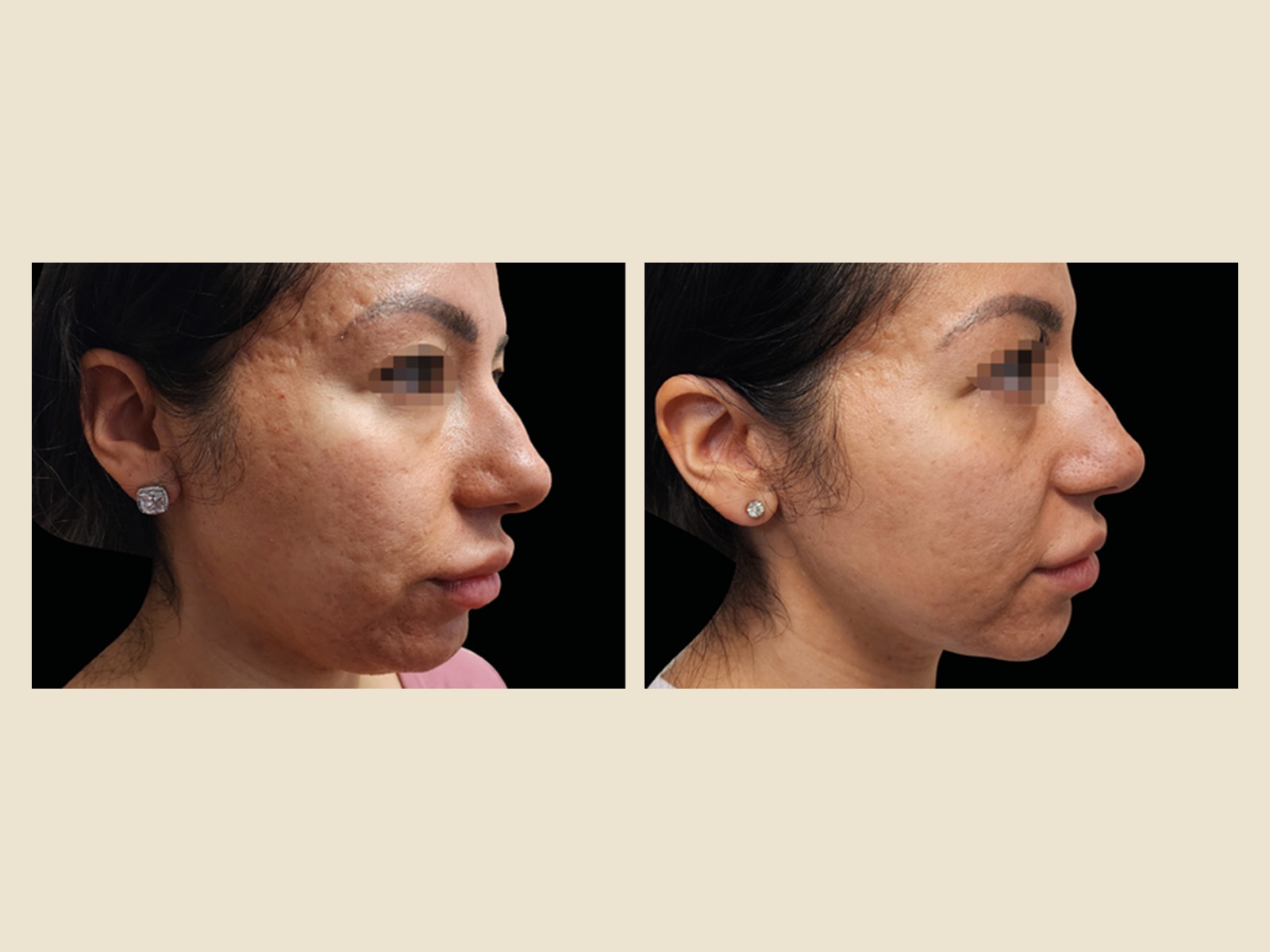 Exion RF Microneedling before and after results at Roots in Tampa, FL