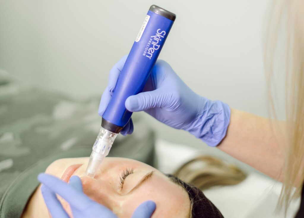 Woman getting mirconeedling treatment | Get SkinPen® Microneedling in Roots Wellness and Medspa at Tampa, Florida