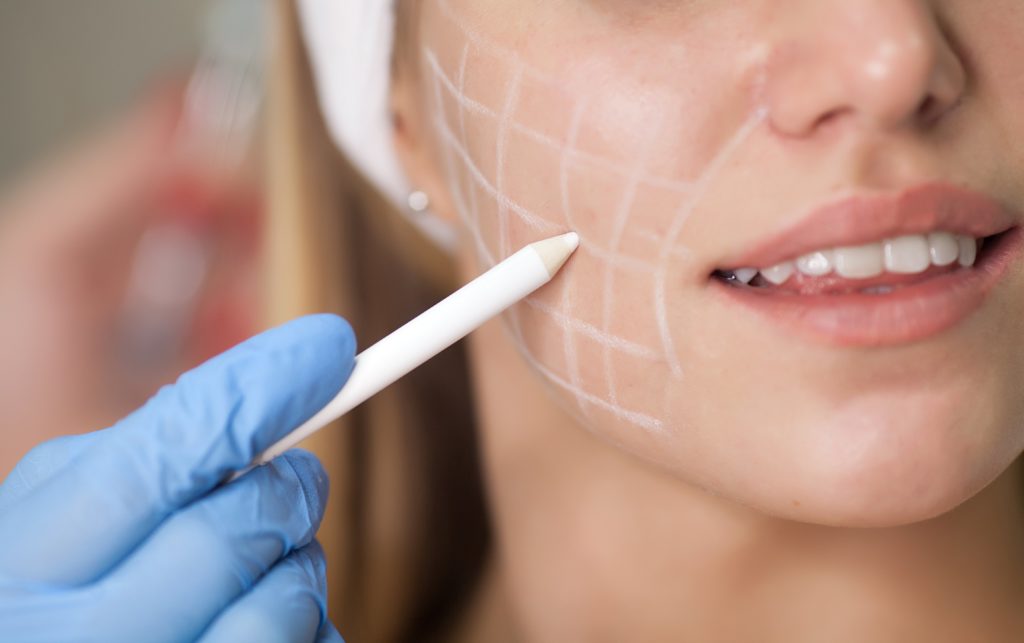 How long before I start to see results of fillers